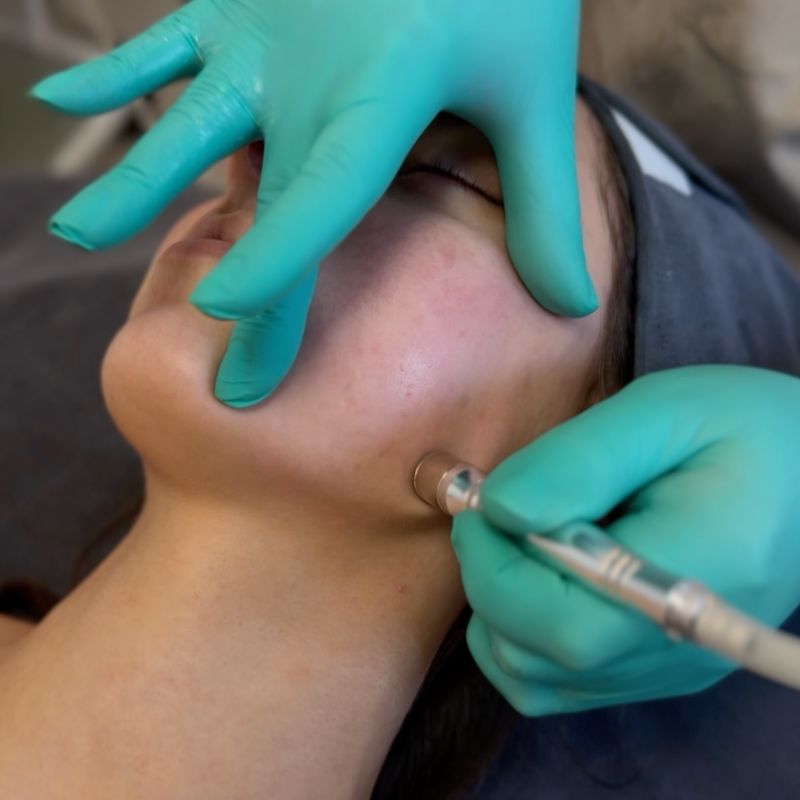 Diamant Micro Dermabrasion